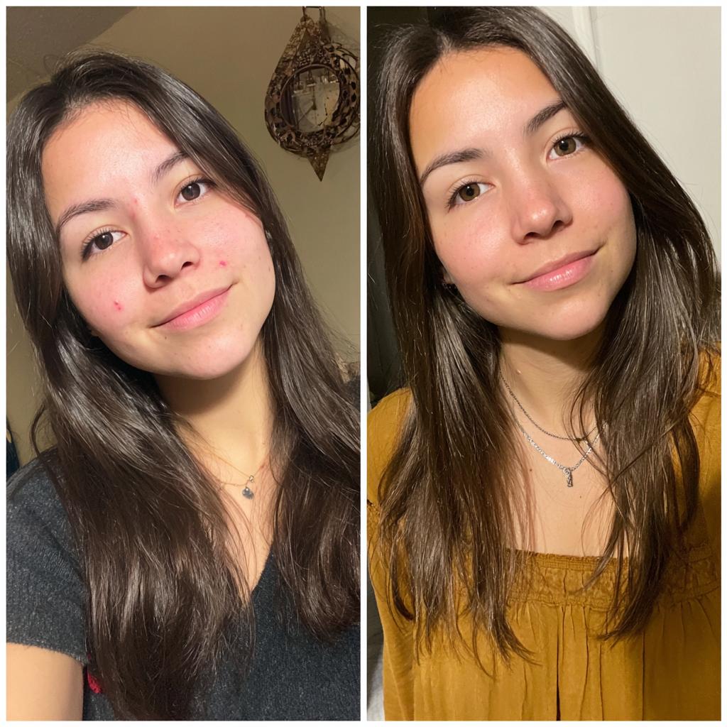 Parche Anti-Acné ClearSkin